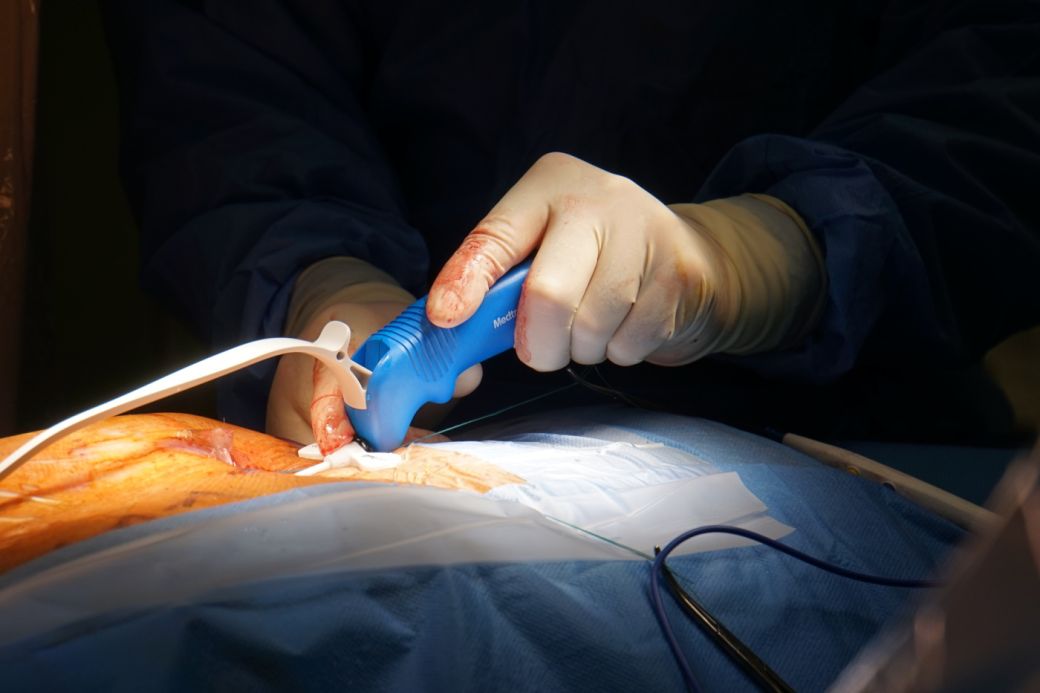 Dnes jsme jako první v Česku implantovali pacientovi nejnovější typ defibrilátoru